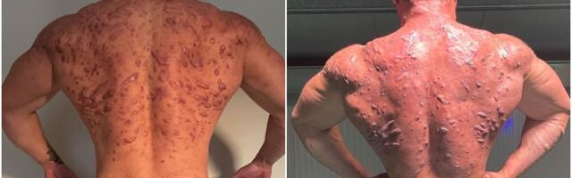 Bodibilder koji je zbog steroida završio sa zastrašujućim ožiljcima na telu