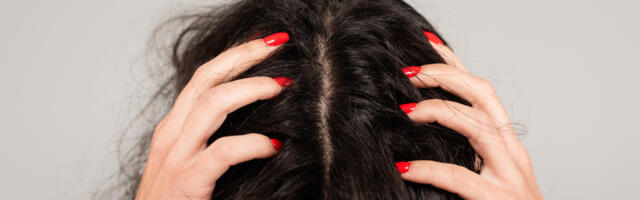 Saznajte šta uzrokuje perut i kako je efikasno tretirati