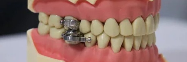 Čudni sistem zaključavanja vilice za uspešno gubljenje kilograma