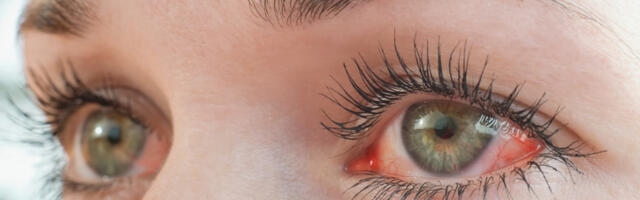Alergijski konjuktivitis: Šta da radite kada vam alergija izaziva suzne oči?
