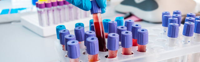 POTREBAN POZITIVAN ILI NEGATIVAN? Kako u Crnu Goru sa ELISA testom