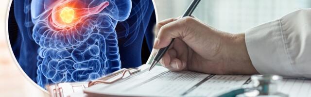 Ovaj karcinom je najopasniji, a simptomi dolaze kasno! Ovu hranu izbegavajte ili smanjite, savetuje naš lekar