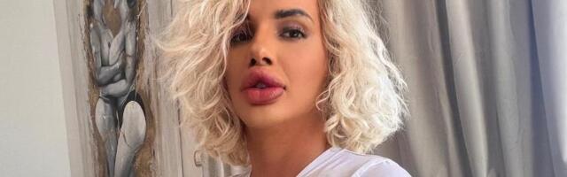 Ovako sam izgledala pre nego što sam uložila 42.000 € da bih imala najveće usne na svetu: Sad me zovu Frankeštajn i kažu da sam majka monstrum