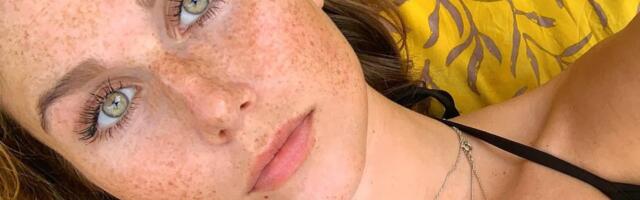 Pegice su cool, ali vam je leti neophodna posebna nega lica
