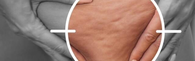 3 rešenja za eliminisanje celulita i kraj narandžine kore