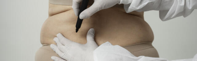 Kontroverzni zahvat zgražava svet: Masno tkivo, za estetske korekcije, sa preminule osobe