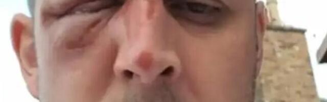 Škot zamalo ostao bez oka zbog poširanja jajeta u mikrotalasnoj