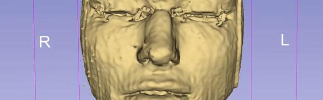 Snimak magnetne rezonance pokazuje šta se dešava s hijaluronskim filerima u licu nakon dužeg vremena (VIDEO)