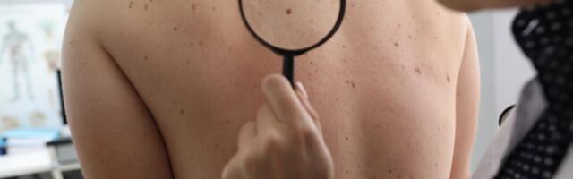 Kako da prirodnim putem uklonite mladeže, bradavice, mitesere ...