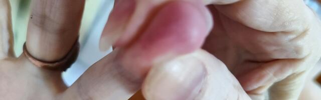 Život dece sa dijabetesom tip 1 u Srbiji: Moderne terapije postoje, ali lekari u domovima zdravlja često ni ne znaju za njih