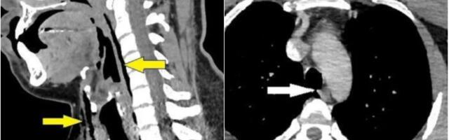 Probušio rupu u dušniku pokušavajući da spreči kijanje