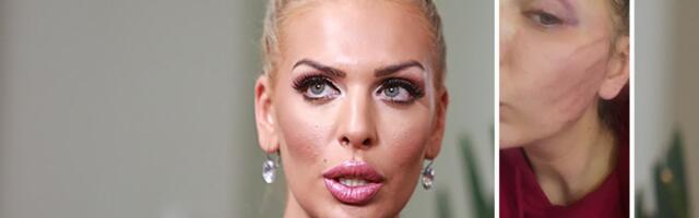 "Bojim se za svoj život" Ava Karabatić objavila uznemirujuće fotografiju povreda: "Ako mi se nešto dogodi..."