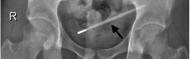 Došao u bolnicu zbog bolova u stomaku: Lekari zanemeli od šoka kad su videli šta je krio u sebi 20 godina, morao na hitnu operaciju