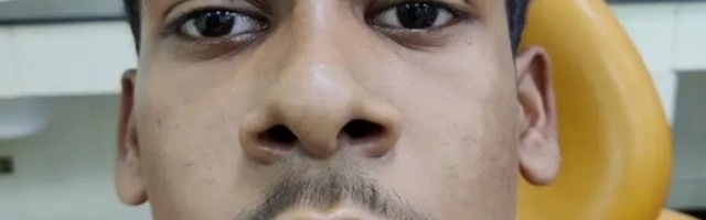 Tinejdžeru sa retkim tumorom uklonjeno 82 zuba iz vilice