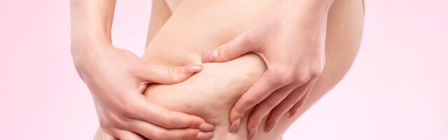 3 promene koje morate da napravite u svom životu da biste smanjili celulit