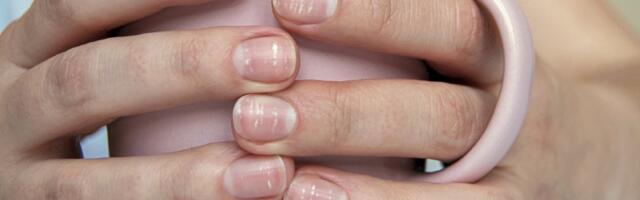 Pojava belih fleka na noktima - leukonihija
