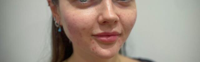 Zaboravite filere, u trendu su injekcije riblje sperme