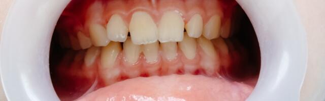 Crni trouglovi između zuba – šta su, zašto nastaju i da li treba da brineš?