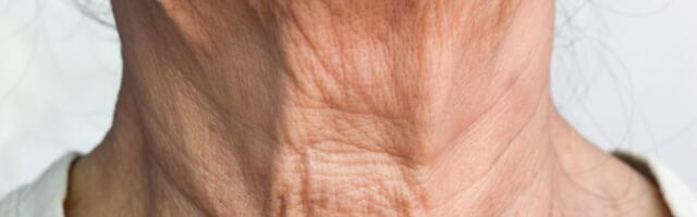 Bore na vratu nestaju bez igle: Prirodni TRIKOVI koji daju vidljive rezultate, samo budite uporni