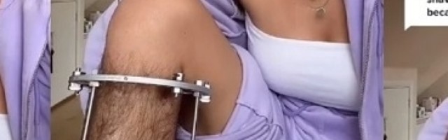 Ne može da obrije nogu nakon nesreće: Mržnja ljudi s kojom se suočava zbog toga je zastrašujuća!