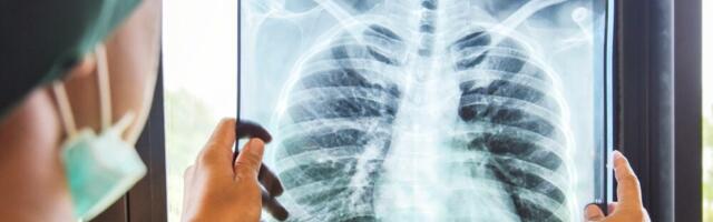 „Batut“: U Srbiji prošle godine registrovano 410 slučajeva tuberkuloze