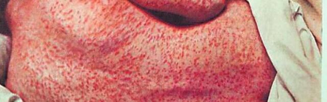 O EPIDEMIJI MAJMUNSKIH BOGINJA NEMA REČI! Ali, na zimu nas ponovo čeka opasan virus...