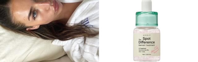 Kako ukloniti akne za 24 sata – Top SOS skincare guide