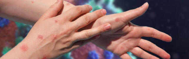 EPIDEMIJA MALIH BOGINJA ŠIRI SE MUNJEVITOM BRZINOM! Najmanje 30 osoba umrlo!