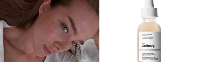 Zimska skincare pravila: Koje kiseline za lice izbegavati?