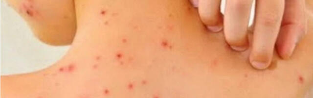 Država osuđena zbog smrti deteta od malih boginja