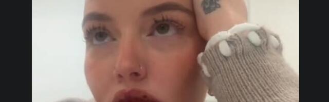 Za punije usne platila 460 EVRA, pa prošla pakao: Dve nedelje nije izlazila iz kuće!