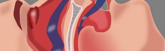Studija pokazuje povezanost između opstruktivne apneje u snu, opšte smrtnosti i kardiovaskularnih događaja
