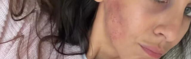 Ivana Dudić sva modra i izgrebana: Glumica doživela nezgodu, otkrila šta joj se dogodilo (foto)