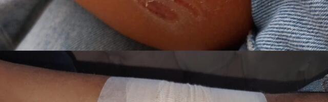 Još jedan napad psa na dijete u Novom Pazaru, od azila još uvek ništa (VIDEO)