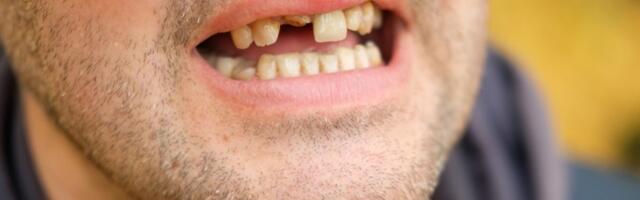 Psiholozi objasnili zašto ljudi SANJAJU da im ISPADAJU ZUBI: JEDAN razlog trebalo bi da vas ZABRINE