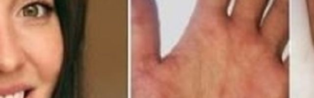 Sara primetila osip po nogama, prvo mislila da ima HIV, a onda otkrila pravu istinu