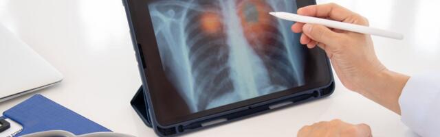 Težak oblik kovida ili gripa može ostaviti dugotrajne posledice u plućima i podstaći razvoj raka