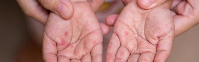 Prijavljena epidemija malih boginja u Padinskoj Skeli