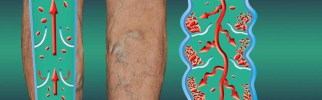 Ruska kaša koja razbija tromb: Prirodni recept spas za proširene i upaljene vene