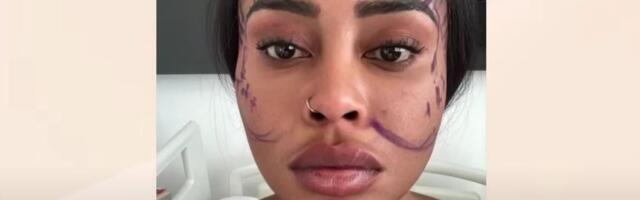 Uradila sam fejslifting sa 28 godina i izgledam kao Kris Džener: Mreže su osule paljbu, evo koliko je koštalo