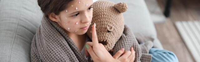 PRVI SIMPTOMI LIČE NA OBIČAN VIRUS, A ONDA KREĆE OSIP: Pedijatar upozorio na simptom morbila koji menja sve - Evo o kojim osobama se POSEBNO mora voditi računa