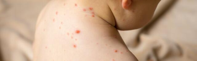 Brzo širenje epidemije malih boginja odnelo najmanje 30 života u jednoj državi: Većina žrtava su DECA!