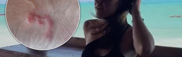 Jovana otišla na odmor iz snova, a vratila se sa živim stanarom u koži koji joj pravi pakao: "Gledala sam kako putuje kroz mene"