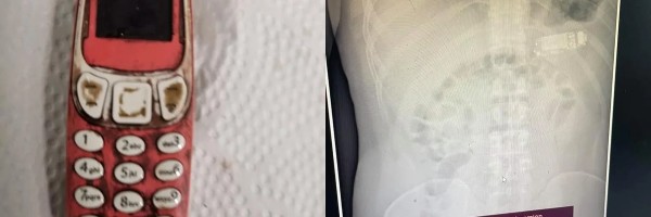 Kosovski Albanac progutao Nokia telefon u komadu