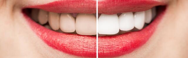 Kako ukloniti žute mrlje sa zuba samo jednim sastojkom