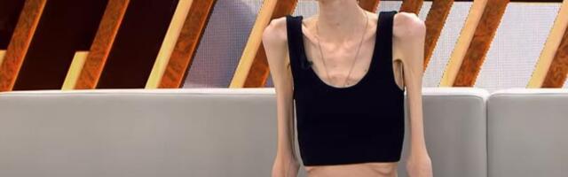 Jela 5 breskvi i malo sira svaki dan da bi smršala: Anastasija sada ima samo 29 kilograma i život joj je borba