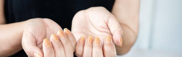 Promena boje noktiju može da vas ubije: Proverite ih pre nego što bude kasno