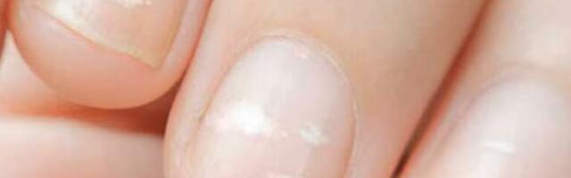 Pogledajte svoje nokte: Ako primetite ove linije, telo vam šalje jako važan signal