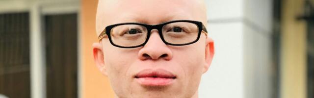 Svetla koža, a crna sudbina: Kako je praznoverje pretvorilo albino crnce u plen bogataša