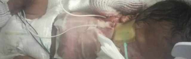 Maleni heroj kom se divi svet: Priča o dečaku rođenom bez kože (FOTO)